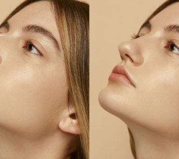 لیفت بینی با نخ چگونه انجام می‌شود؟